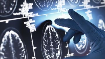 طريقة جديدة لإبطاء تدهور الذاكرة لدى مرضى الألزهايمر