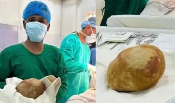 حجمها يقترب من وزن طفل حديث الولادة.. إزالة حصوة عملاقة من مثانة رجل حجمها يقترب من وزن طفل حديث الولادة.. إزالة حصوة عملاقة من مثانة رجل
