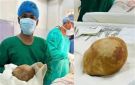حجمها يقترب من وزن طفل حديث الولادة.. إزالة حصوة عملاقة من مثانة رجل - lb