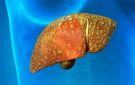 علاج جديد لسرطان الكبد