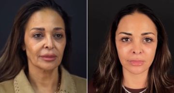 داليا البحيري بعد خضوعها لعملية شد الوجه: حاسه أن أنا لسه صغيرة