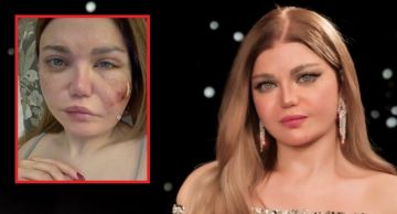 ياسمين الخطيب تعلن إصابتها بعدوى بكتيرية في وجهها وخضوعها لجراحة دقيقة