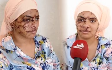 نجت من الموت وفقدت ملامحها.. شهادة مروعة من ضحية تشرميل على يد طليقها نجت من الموت وفقدت ملامحها.. شهادة مروعة من ضحية تشرميل على يد طليقها