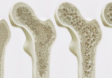 أشهر 7 خرافات عن هشاشة العظام.. تعرفوا عليها