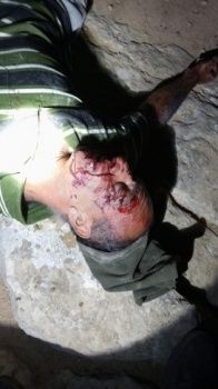 المستوطنون يواصلون ارهابهم: اعتداء دموي يخلف إصابات شرق يطا