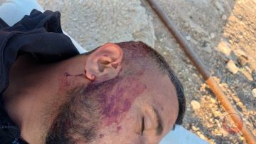 إصابة شاب في مسافر يطا بعد اعتداء المستوطنين عليه بالضرب إصابة شاب في مسافر يطا بعد اعتداء المستوطنين عليه بالضرب