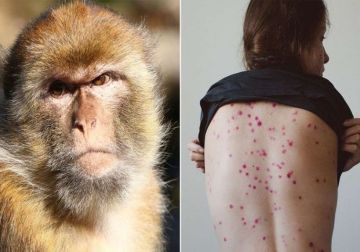 الصحة العالمية: اكتشاف سلالة هجينة من فيروس جدرى القرود