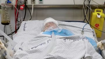 ميرا.. طفلة فقدت عظم رأسها وحلم الطفولة في أتون الحرب