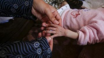 صورة ولادة طفلة بلا دماغ بغزة تثير صدمة مع تزايد حالات تشوه الأجنة