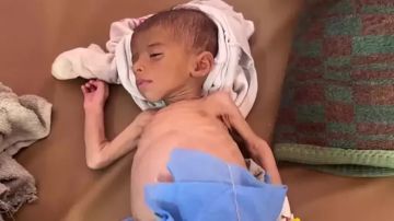 حالتا وفاة خلال الـ 24 ساعة الماضية جراء التجويع وسوء التغذية حالتا وفاة خلال الـ 24 ساعة الماضية جراء التجويع وسوء التغذية