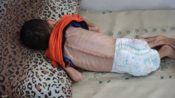 غزة: 10 وفيات بينها ثلاثة أطفال نتيجة المجاعة وسوء التغذية خلال الساعات الماضية