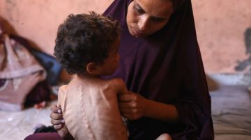 8 وفيات جديدة نتيجة المجاعة وسوء التغذية 8 وفيات جديدة نتيجة المجاعة وسوء التغذية