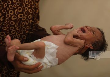 3 وفيات نتيجة التجويع في غزة خلال الساعات الـ24 الماضية