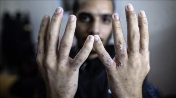 إعلام الأسرى: تفاقم انتشار مرض السكايبوس وتصاعد القمع داخل سجن جلبوع