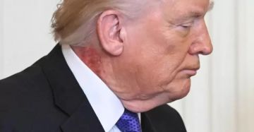 طفح جلدي على رقبة ترامب يثير تساؤلات حول حالته الصحية