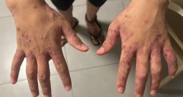 داء الجرب يجتاح سجون الاحتلال واتهامات بتعذيب ممنهج للأسرى