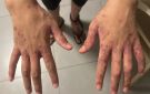 داء الجرب يجتاح سجون الاحتلال واتهامات بتعذيب ممنهج للأسرى