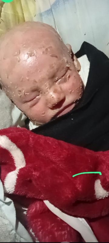 الطفلة الشمعية أيسل.. صراع مبكر مع المرض داخل خيمة نزوح الطفلة الشمعية أيسل.. صراع مبكر مع المرض داخل خيمة نزوح