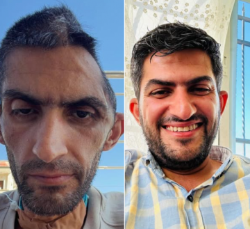 بنصف جمجمة.. الصحفي بني مفلح يصارع آثار القهر والعذاب في سجون الاحتلال