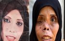بملامح غيبها القصف.. أم غزية تروي مأساة فقدان طفلتها ونفور أطفالها من شكلها المشوه