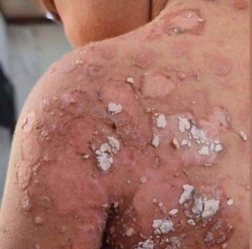 تسجيل أكثر من 9 آلاف إصابة بأمراض جلدية معدية خلال أسبوعين في غزة تسجيل أكثر من 9 آلاف إصابة بأمراض جلدية معدية خلال أسبوعين في غزة