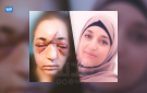 حاولت تخليص طفلها من الاعتقال.. جنود الاحتلال يكسرون جمجمة فلسطينية بالعيساوية