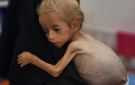 مسؤول طبي : نحو 1.6 مليون شخص مهددون بالمجاعة وسوء التغذية بغزة