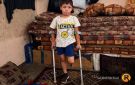 قصة مصورة أحمد.. إصابة كان يمكن علاجها فانتهت ببتر ساقه - ps