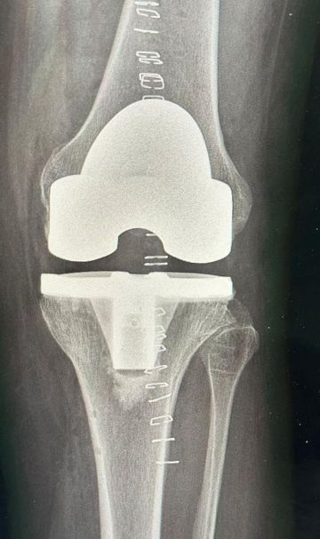 عملية ناجحة بتقنية الروبوت تنهي معاناة مريضة من آلام الركبة في مستشفى الدرعية العام