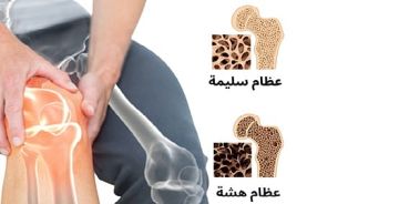 في اليوم العالمي لهشاشة العظام.. 7 خرافات شائعة يفندها الطب في اليوم العالمي لهشاشة العظام.. 7 خرافات شائعة يفندها الطب