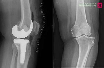 مستشفى الدكتور سليمان الحبيب بالقصيم ينهي معاناة ستينية بعملية استبدال مفصل ركبة نوعية مستشفى الدكتور سليمان الحبيب بالقصيم ينهي معاناة ستينية بعملية استبدال مفصل ركبة نوعية