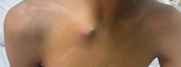 مدينة الملك سعود الطبية تنقذ شابا تعرض لإصابة خطيرة أثناء ممارسته ركوب الخيل مدينة الملك سعود الطبية تنقذ شابا تعرض لإصابة خطيرة أثناء ممارسته ركوب الخيل