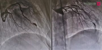 مستشفى الدكتور سليمان الحبيب بالتخصصي يزيل انسدادات ويصلح توسعا في الشرايين التاجية للقلب بتقنية حديثة