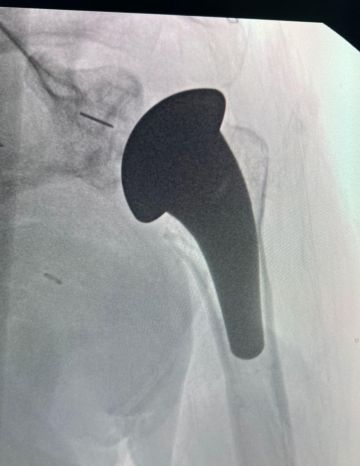 مدينة الملك سعود الطبية تنجح في أول عملية استبدال كامل لمفصل الكتف بتقنية متقدمة