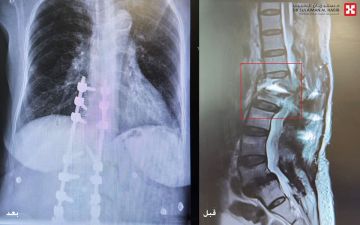 مستشفى الدكتور سليمان الحبيب بالخبر يعيد قدرة المشي لسبعينية أصيبت بتشوه بالعمود الفقري نتيجة 5 عمليات سابقة غير ناجحة