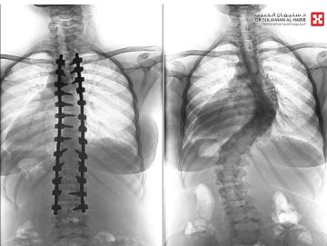 مستشفى الدكتور سليمان الحبيب بالفيحاء في جدة يجرى عملية ناجحة لتقويم جنف مزدوج بزاوية 63 و45 درجة