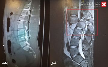مستشفى الدكتور سليمان الحبيب بالريان ينهي معاناة عشريني مع الشلل التام بعد تعرضه لكسر العمود الفقري نتيجة حادث مروع