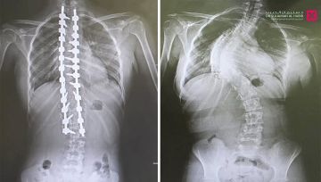 مستشفى الدكتور سليمان الحبيب بالقصيم يجرى عملية ناجحة لتقويم جنف بزاوية 95 درجة