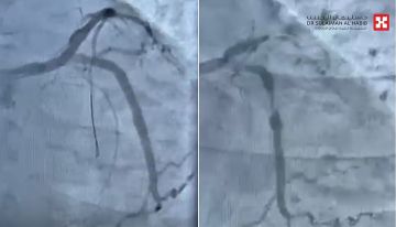 مستشفى الدكتور سليمان الحبيب بالخبر ينقذ حياة مراجع توقف قلبه بسبب انسداد كلي للشريان النازل