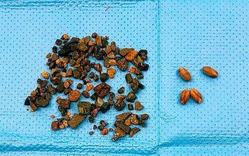 استخراج 150 جسما غريبا من مريء طفل بالمنظار في مستشفى الولادة بالمدينة استخراج 150 جسما غريبا من مريء طفل بالمنظار في مستشفى الولادة بالمدينة