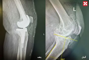 مستشفى الدكتور سليمان الحبيب بالخبر يجري عملية زراعة مفصل معقدة بتقنية الروبوت الجراحي لإعادة قدرة المشي لثمانينية