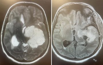 نجاح جراحة معقدة لاستئصال ورم دماغي كبير لشابة بالطائف