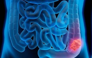 بعد ارتفاع حالات الإصابة بين الشباب.. دراسة: التعرض لسموم بكتيرية في الأمعاء بمرحلة الطفولة قد يتسبب بسرطان القولون في سن مبكرة