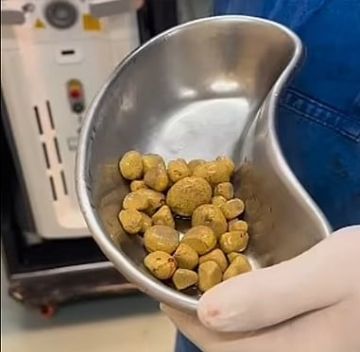 بـ35 حصوة في المثانة.. شاهد نهاية الإفراط في شرب المشروبات الغازية