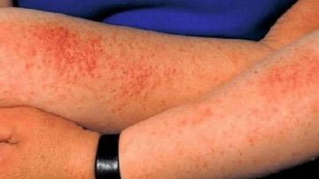 استشاري: التسمم الشمسي ليس تسمما فعليا بل التهاب حاد يهدد الجلد .. فيديو