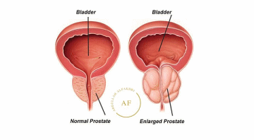 طبيب مسالك يحذر: تضخم البروستات.. المرض الأول للرجال بعد الخمسين