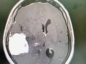 جراحة دقيقة تنقذ حاجة إندونيسية من ورم في الدماغ بالمدينة المنورة