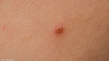 لا بد من استشارة طبية.. طبيب أمراض جلدية: علامات بسيطة على بشرتك قد تشير إلى الإصابة بمرض خطير