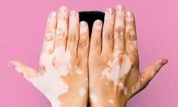 اليوم العالمي للبهاق.. توعية بالمرض وتفعيل الاستشارات الطبية وإمكانات العلاج اليوم العالمي للبهاق.. توعية بالمرض وتفعيل الاستشارات الطبية وإمكانات العلاج