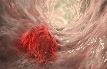 اختراق علمي في مواجهة سرطان الأمعاء.. خلايا تتنكر لتنتشر في الجسم وتهاجم الشباب